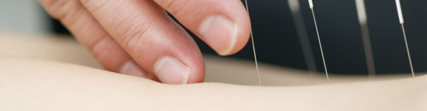 Close of photo of Dry needling technique